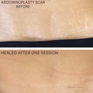 body scar camouflage