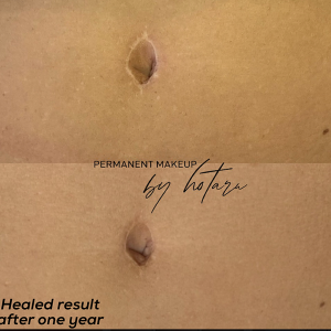 before and after scar camouflage