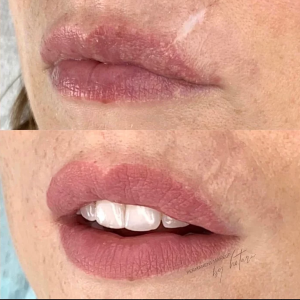 permanent lips and scar camouflage