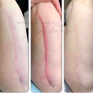 scar camouflage on leg