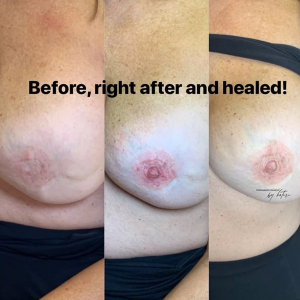 before, after and healed areola tattoo, louiseville