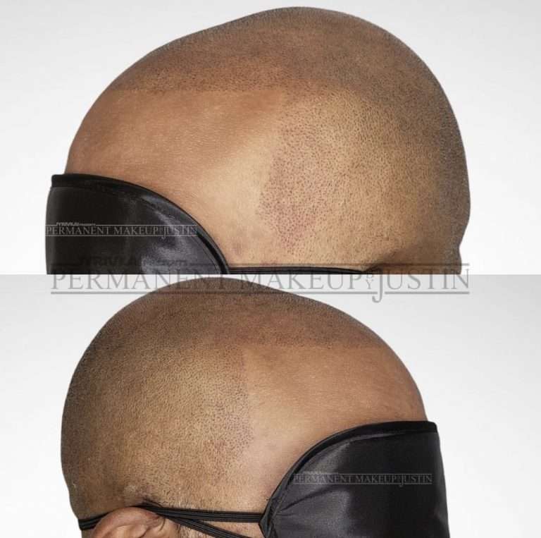 scalp micropigmentation louisville